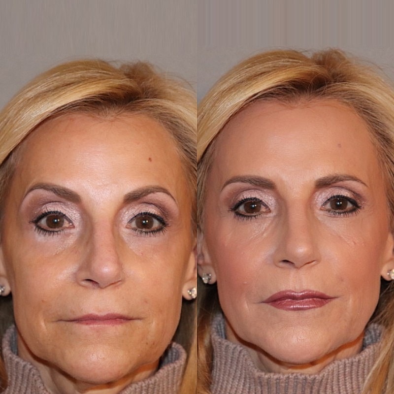 Fillers Before & After