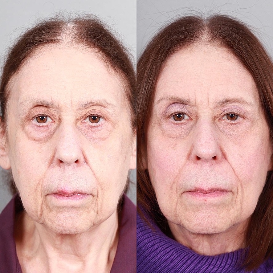 Fillers Before & After