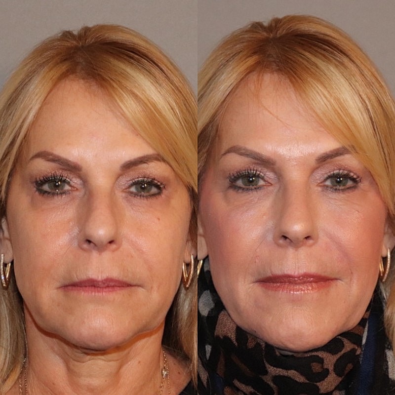 Fillers Before & After