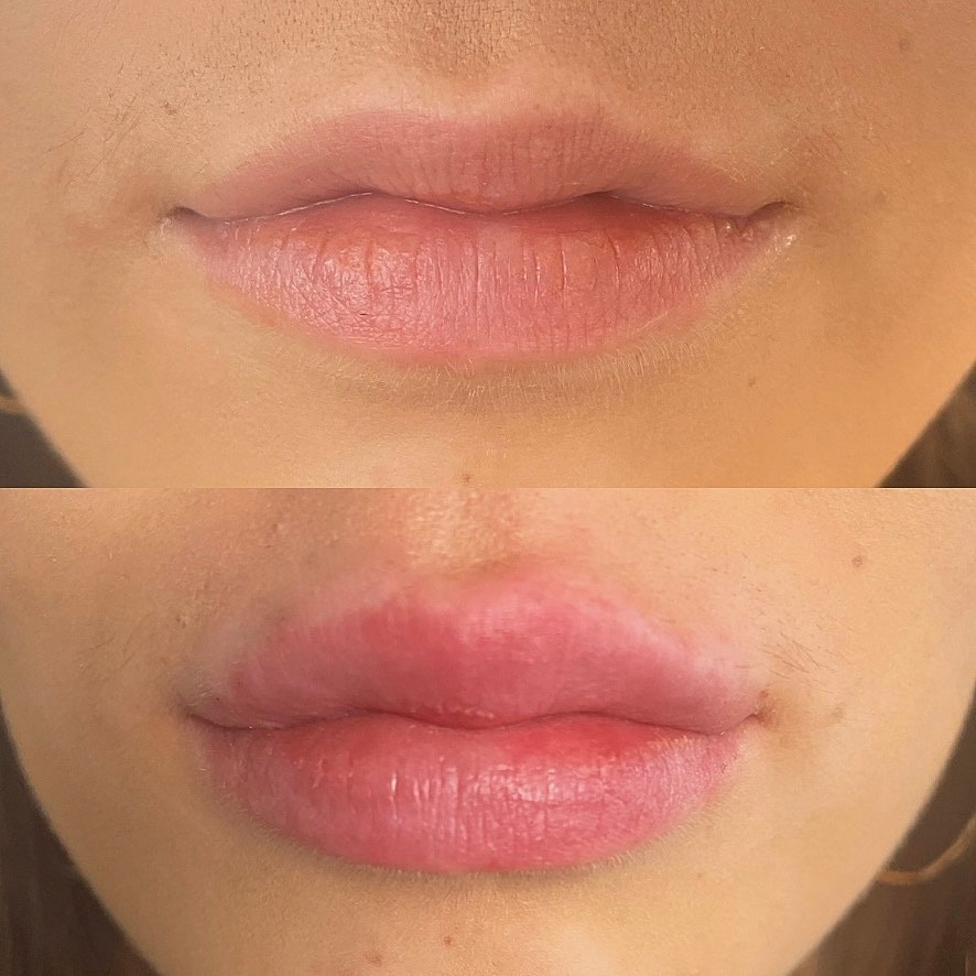 Fillers Before & After