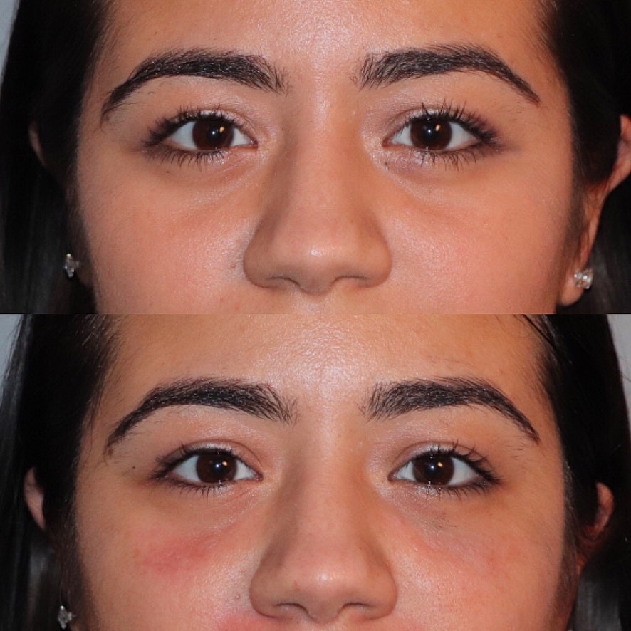 Fillers Before & After