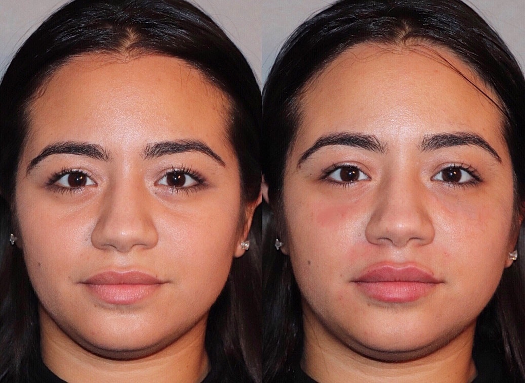 Fillers Before & After