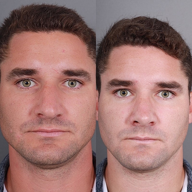 Rhinoplasty Before & After