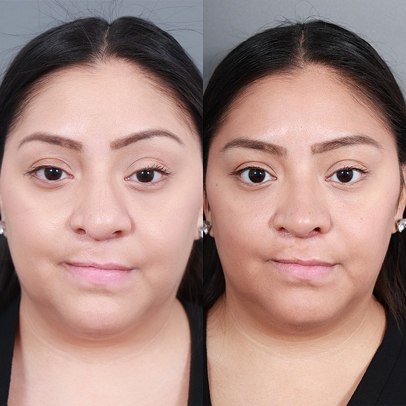 Rhinoplasty Before & After