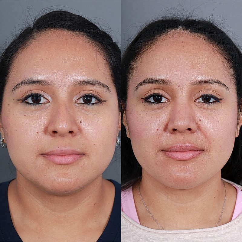 Rhinoplasty Before & After