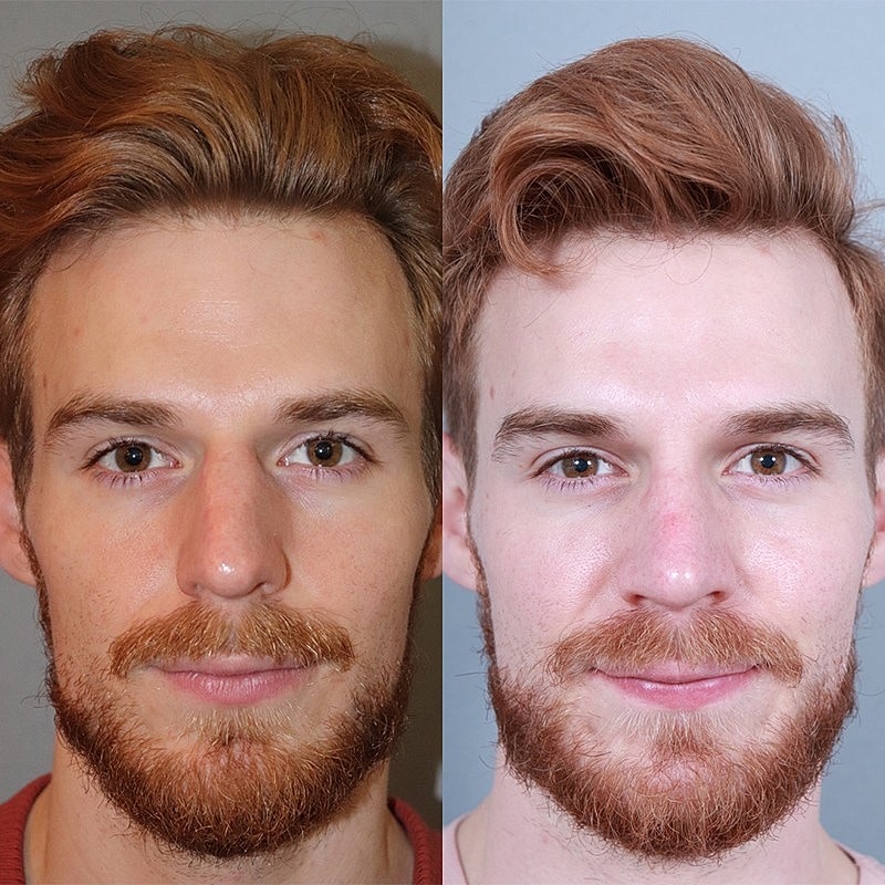 Rhinoplasty Before & After