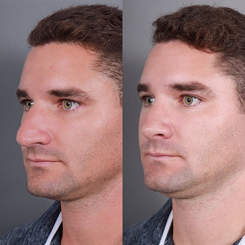 Rhinoplasty Before & After