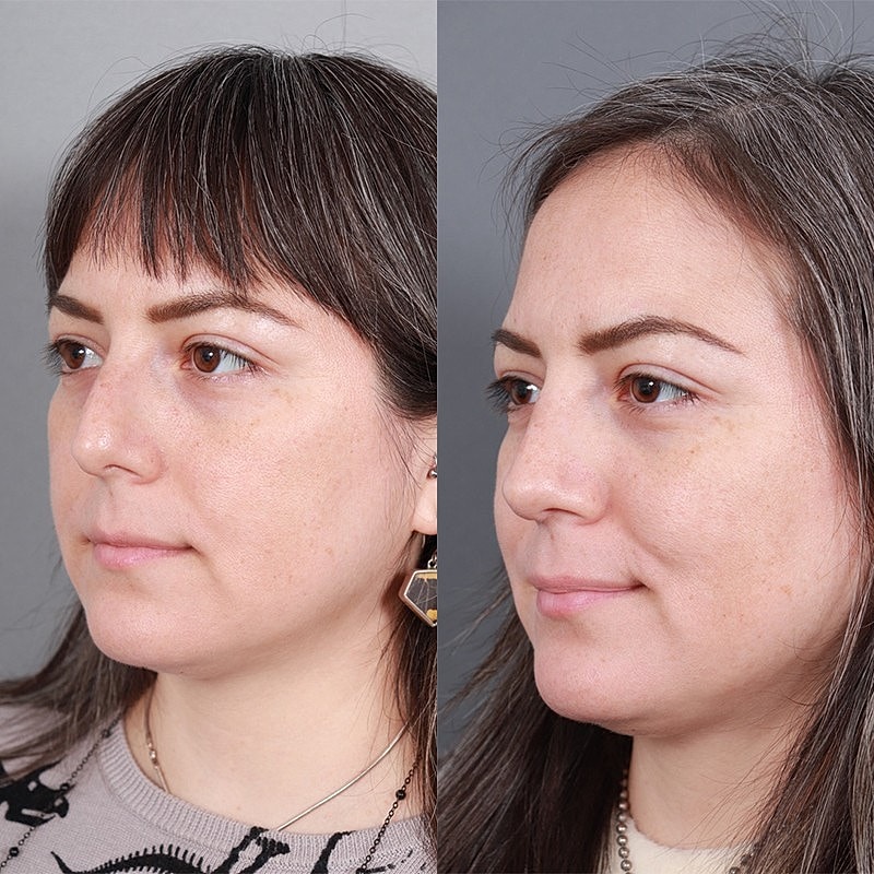 Rhinoplasty Before & After