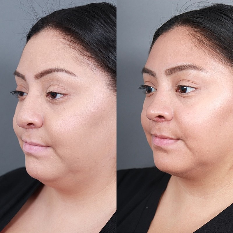 Rhinoplasty Before & After