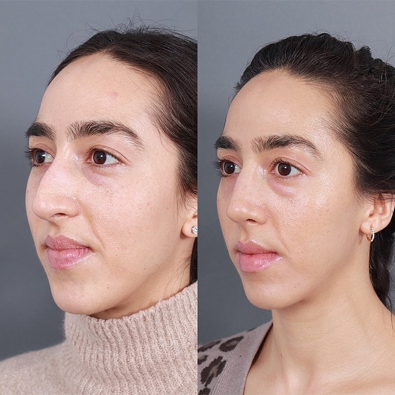 Rhinoplasty Before & After
