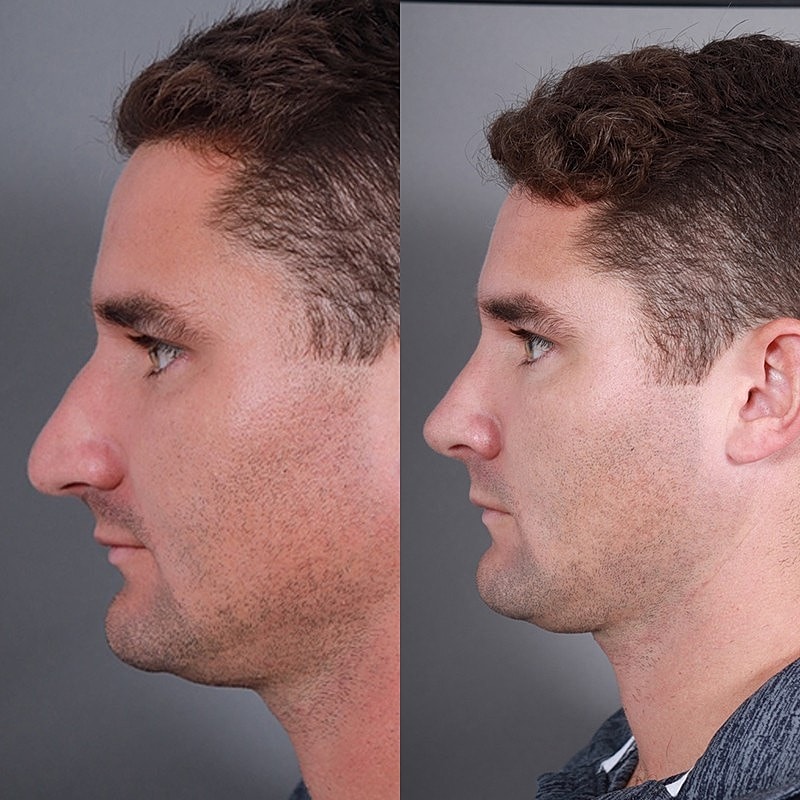 Rhinoplasty Before & After