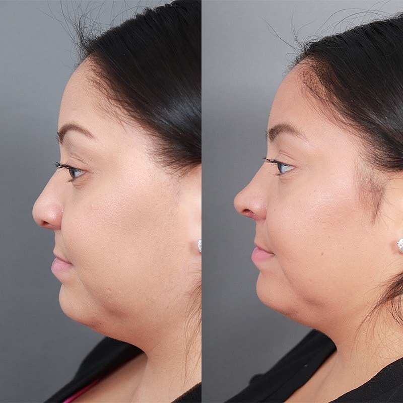 Rhinoplasty Before & After