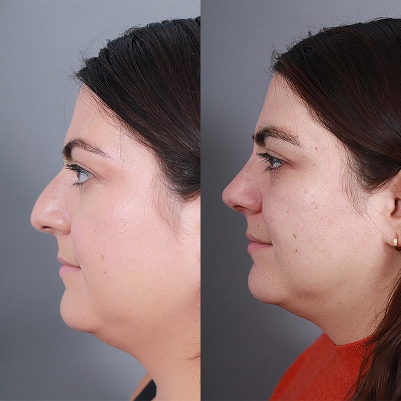 Rhinoplasty Before & After