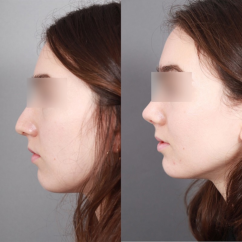 Rhinoplasty Before & After