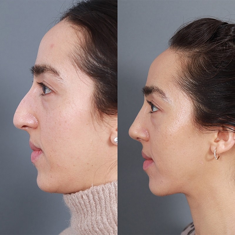 Rhinoplasty Before & After