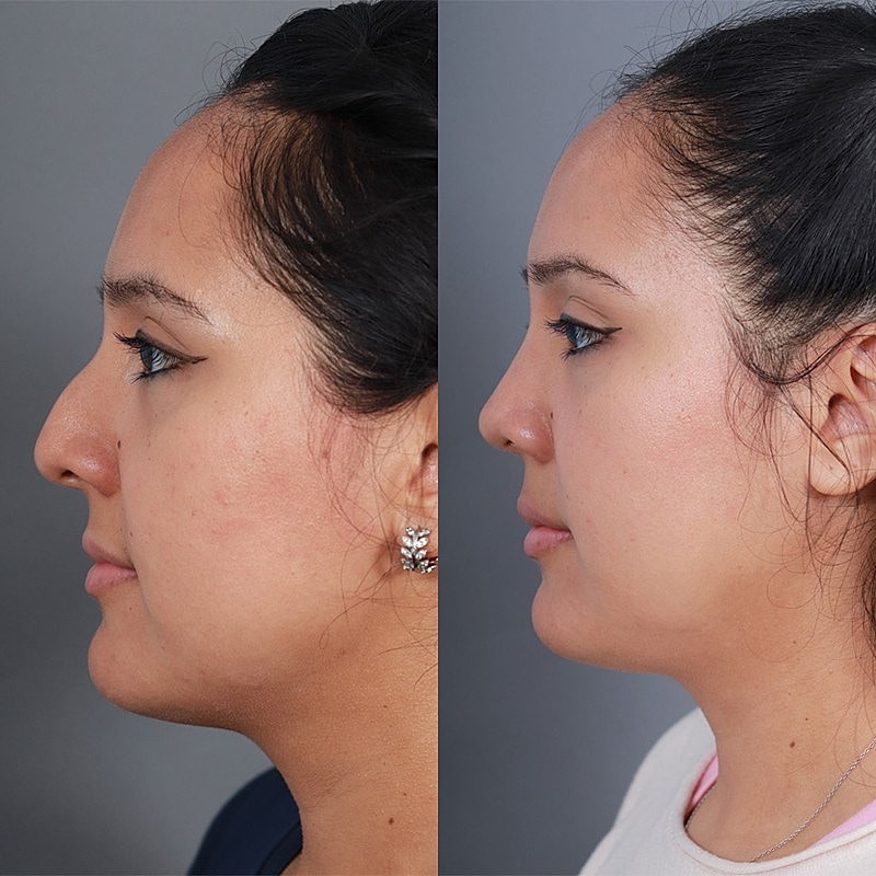 Rhinoplasty Before & After