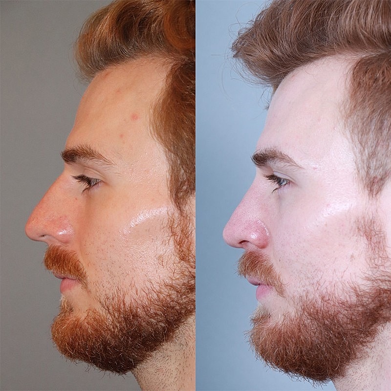 Rhinoplasty Before & After