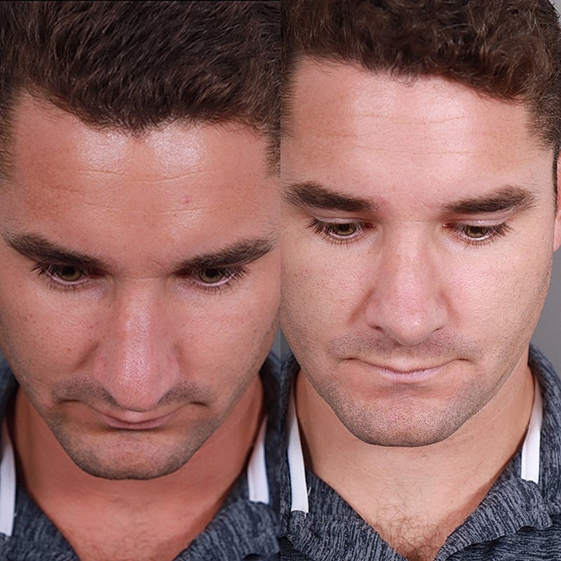 Rhinoplasty Before & After