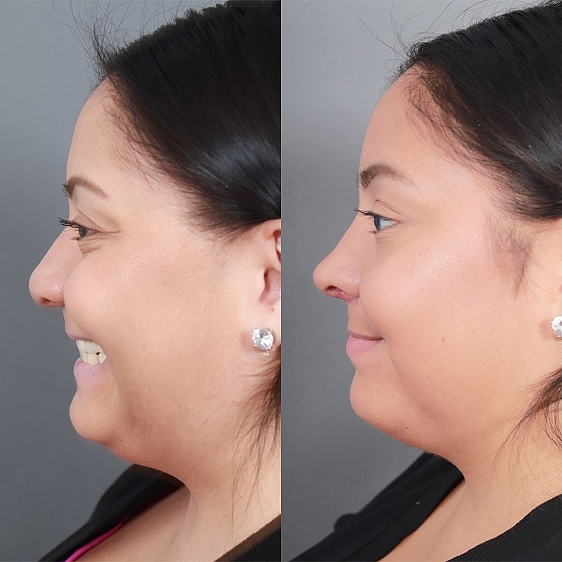 Rhinoplasty Before & After