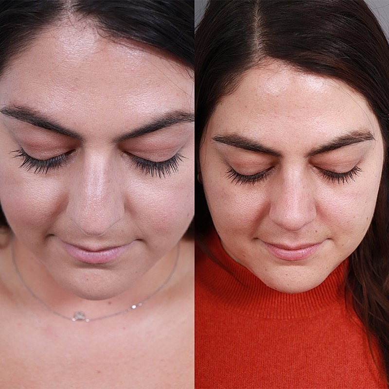Rhinoplasty Before & After