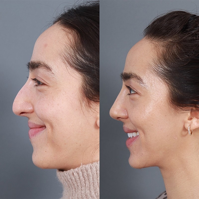 Rhinoplasty Before & After