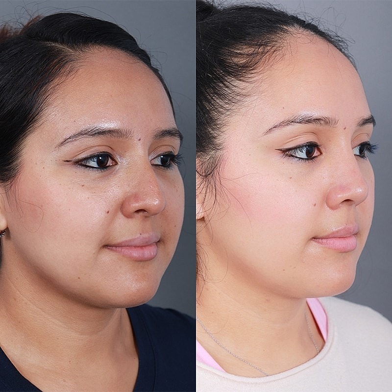 Rhinoplasty Before & After