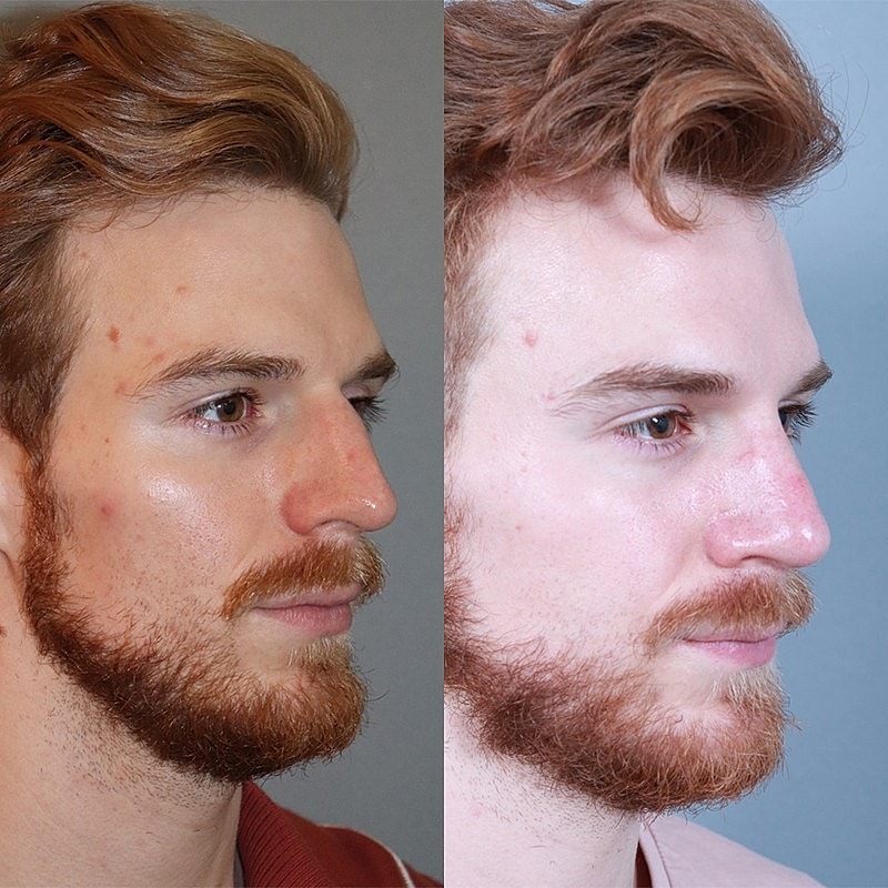 Rhinoplasty Before & After