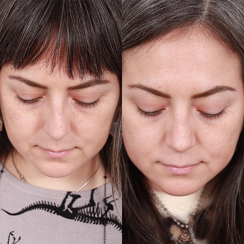 Rhinoplasty Before & After