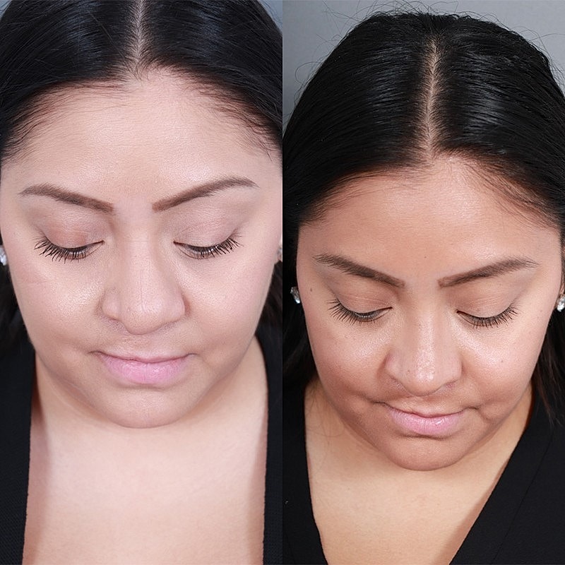 Rhinoplasty Before & After