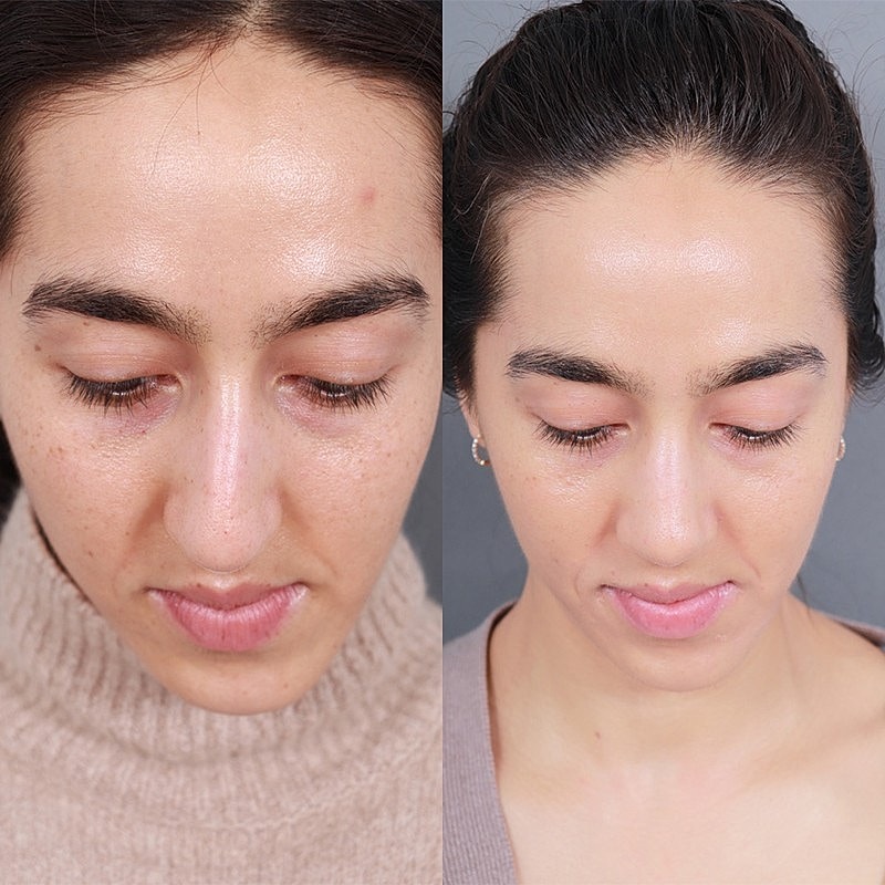 Rhinoplasty Before & After