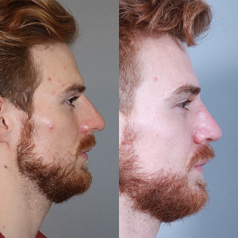 Rhinoplasty Before & After