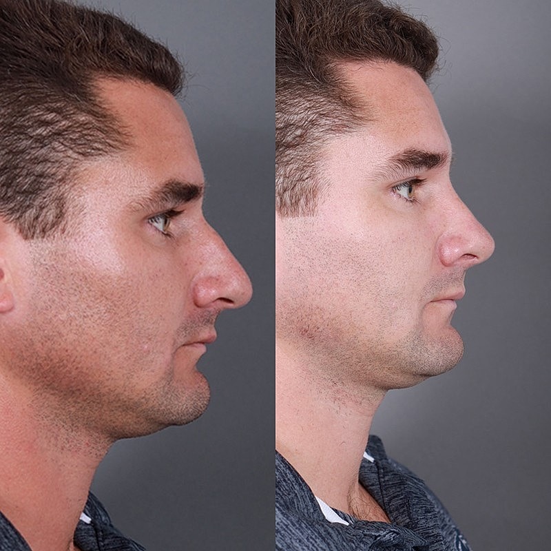 Rhinoplasty Before & After