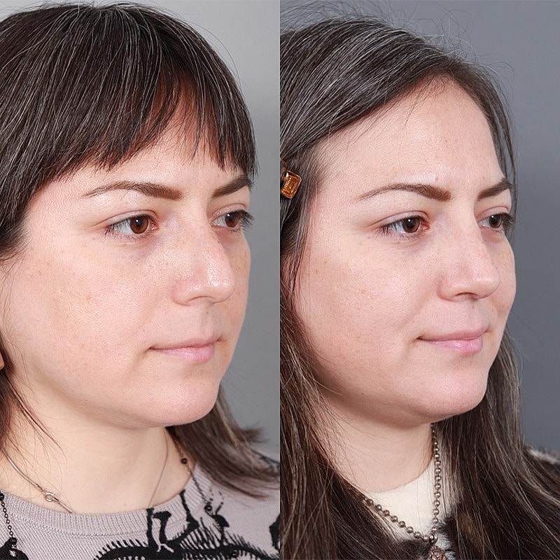 Rhinoplasty Before & After