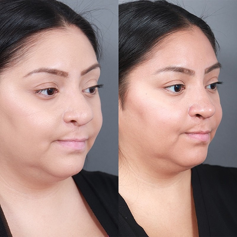 Rhinoplasty Before & After