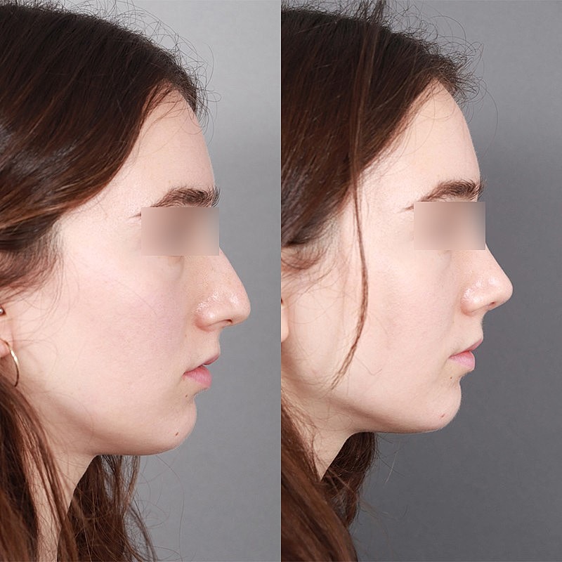 Rhinoplasty Before & After