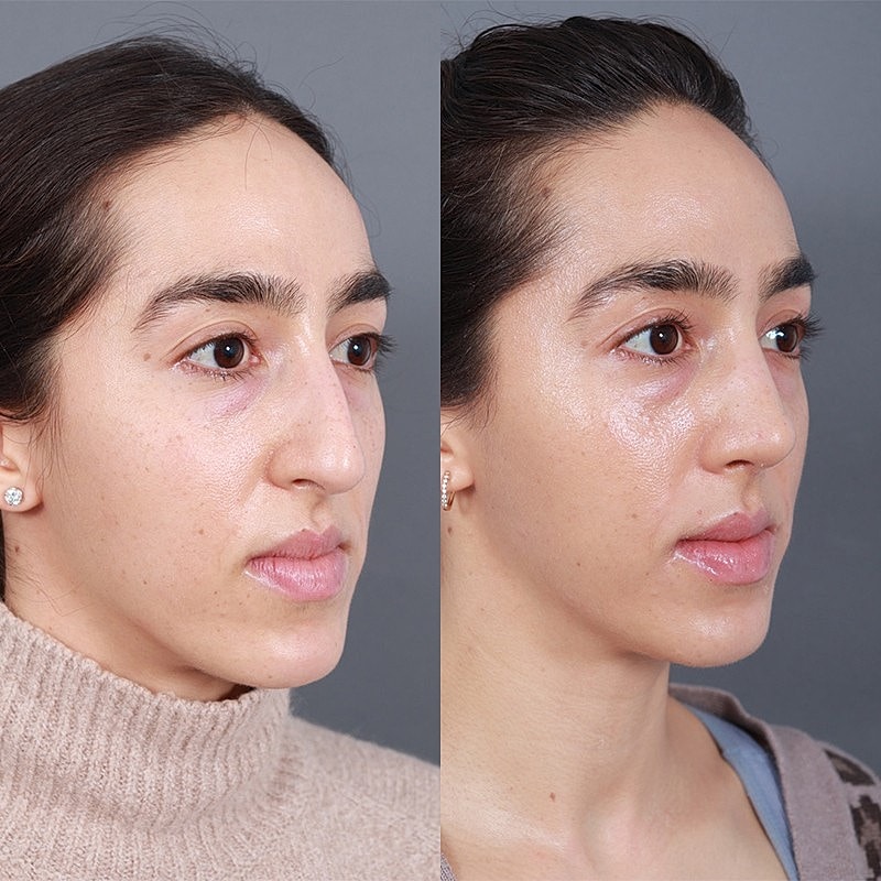 Rhinoplasty Before & After