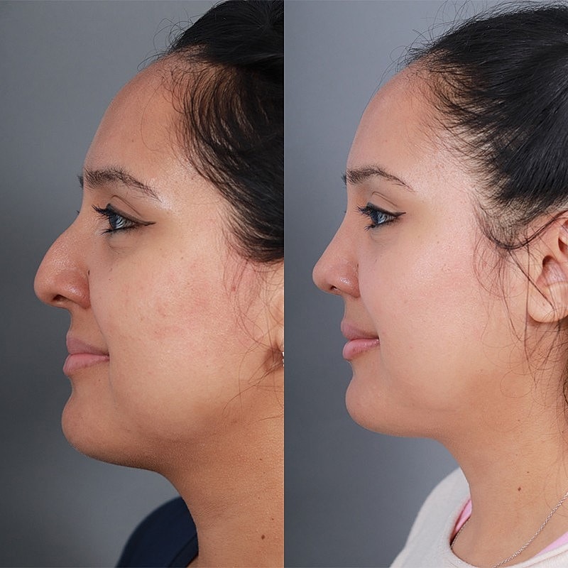 Rhinoplasty Before & After