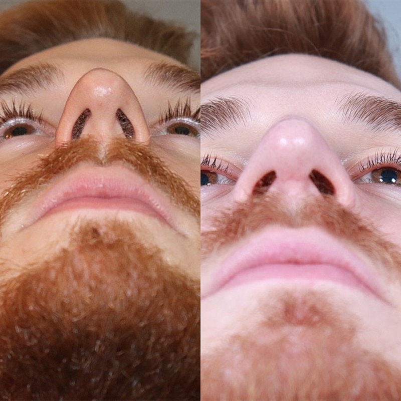 Rhinoplasty Before & After