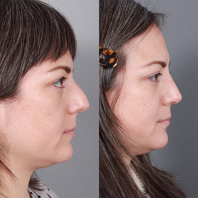 Rhinoplasty Before & After