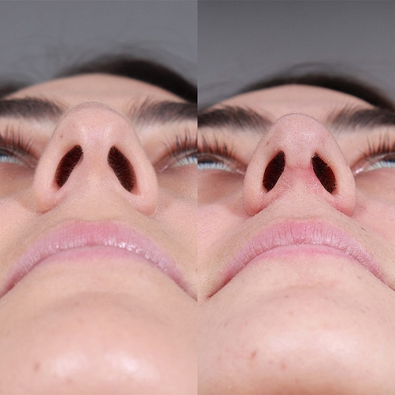 Rhinoplasty Before & After