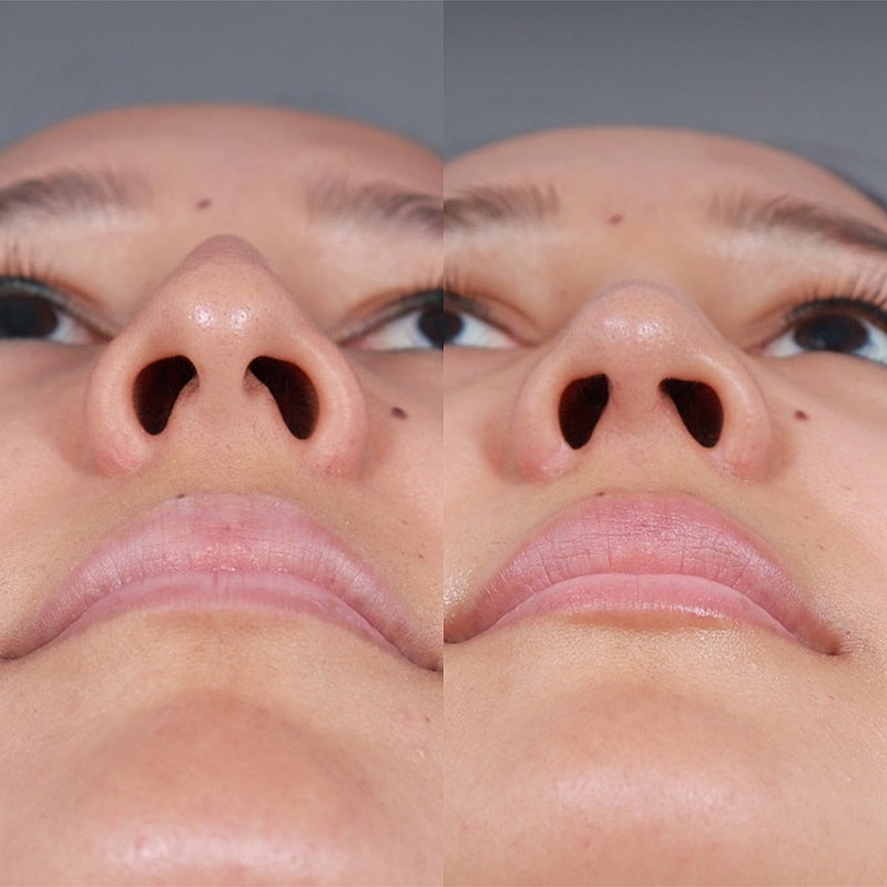 Rhinoplasty Before & After