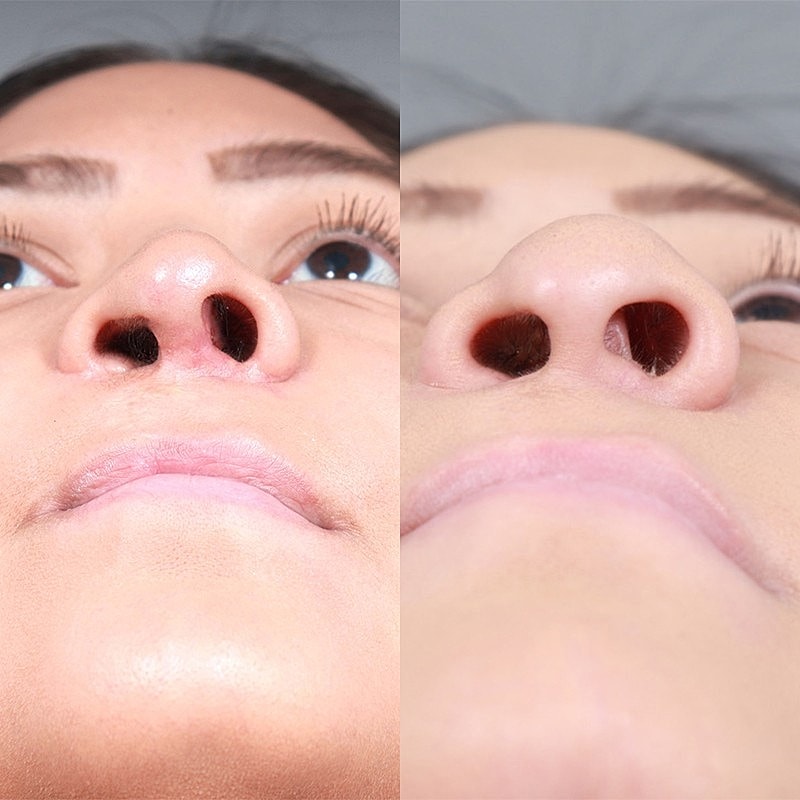 Rhinoplasty Before & After