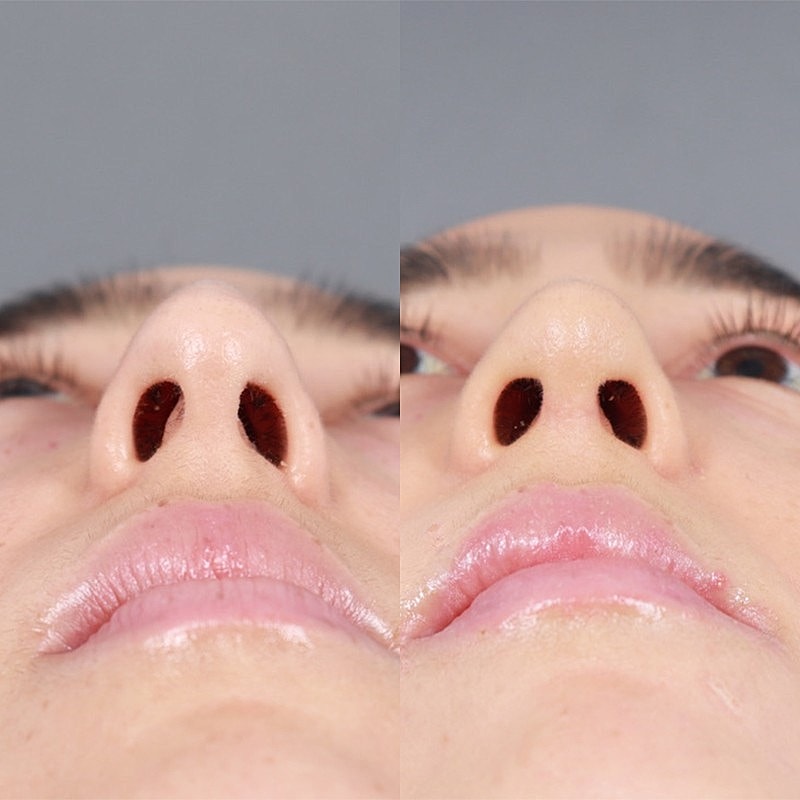 Rhinoplasty Before & After