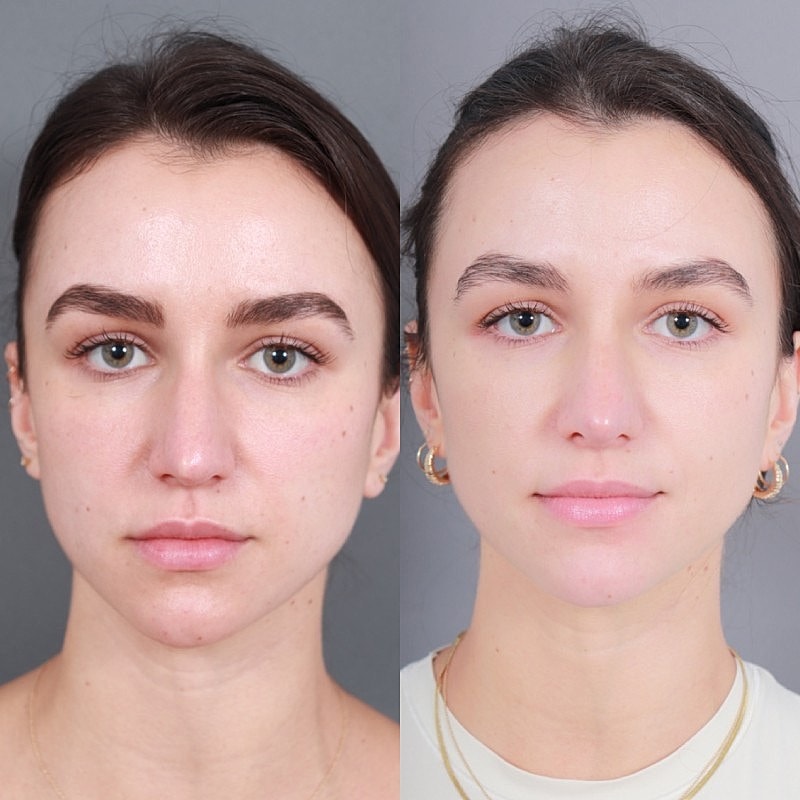 Before & After