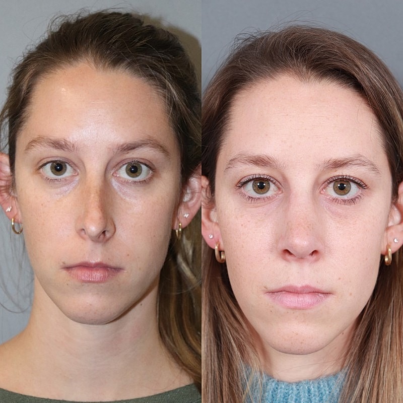Before & After