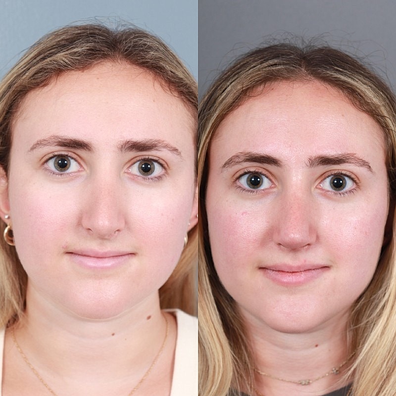 Before & After
