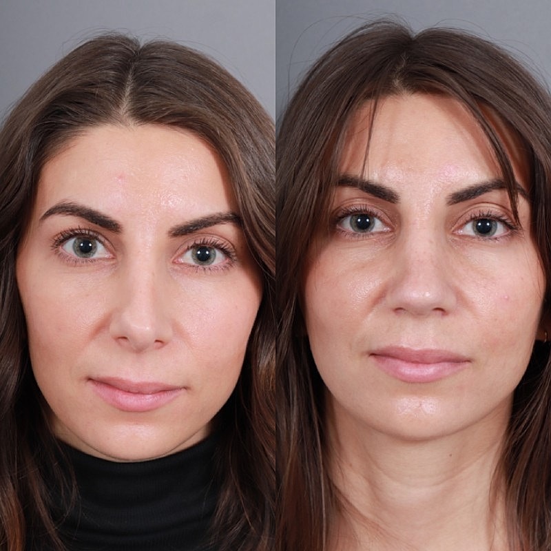 Revision Rhinoplasty Before & After