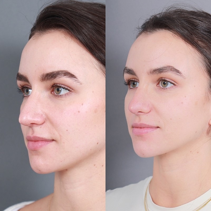 Before & After