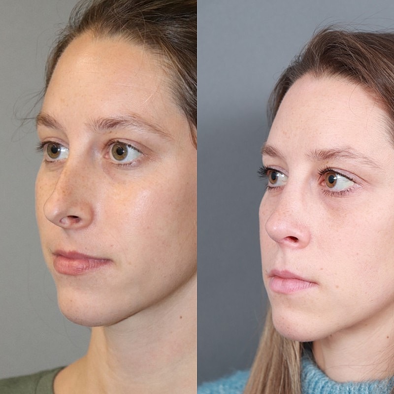 Before & After