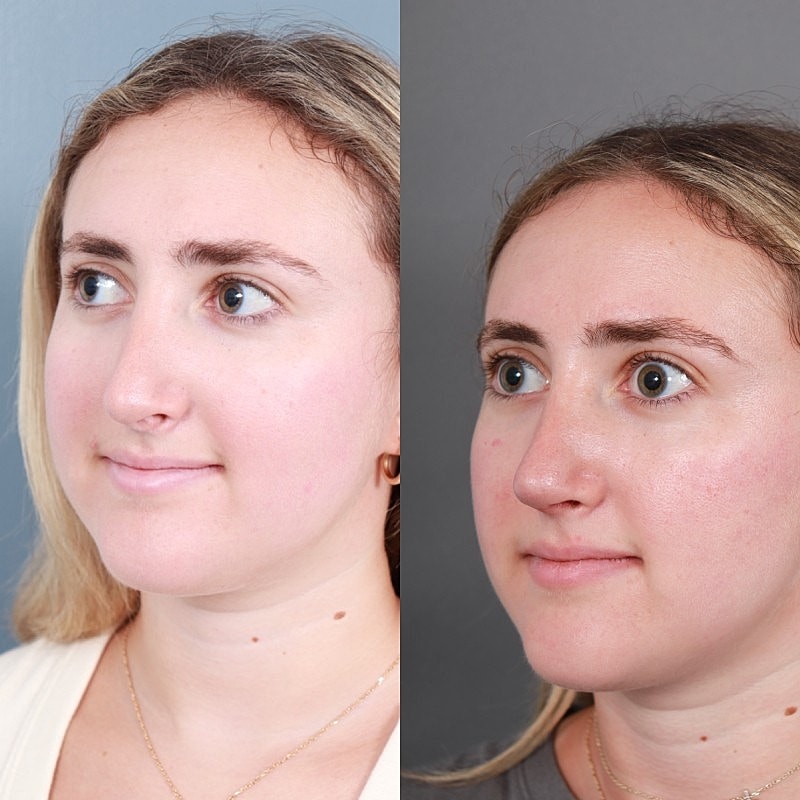 Before & After
